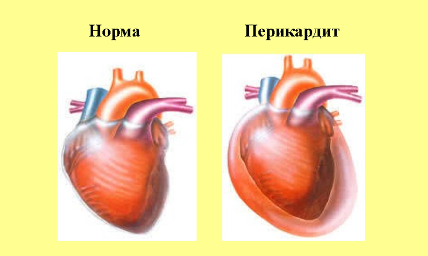 Перикардит