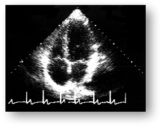 Эхокардиография